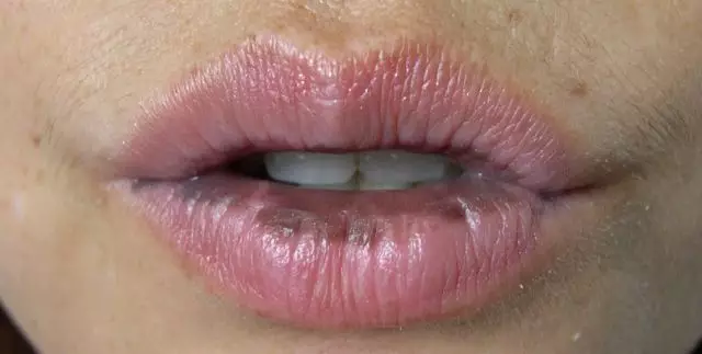 口唇黑斑不要大意,小心是内脏癌